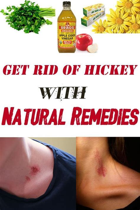 How To Get Rid Of Hickey With Natural Remedies Remedies Natural
