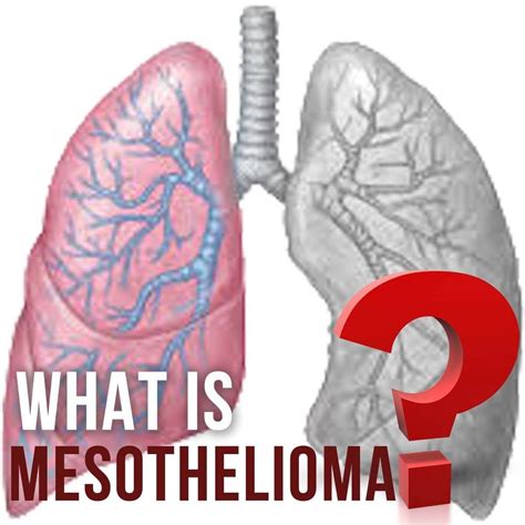 What Is Survival Rates Of Mesothelioma Mesothelioma Cancer Cancer Signs