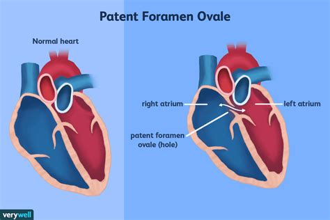 Migrañas Y Foramen Oval Permeable Medicina Básica