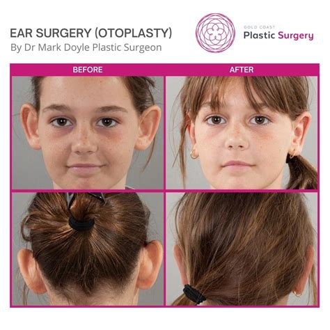 Ear Reduction Before And After Images Sunshine Coast Gold Coast