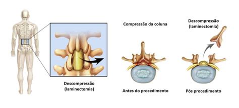Laminectomia Quais Os Riscos E Cuidados Da Cirurgia Dr Ricardo Teixeira
