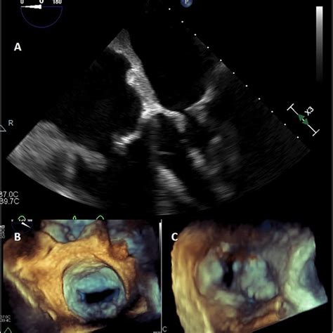 Transthoracic Echocardiogram A Apical Four Chamber View