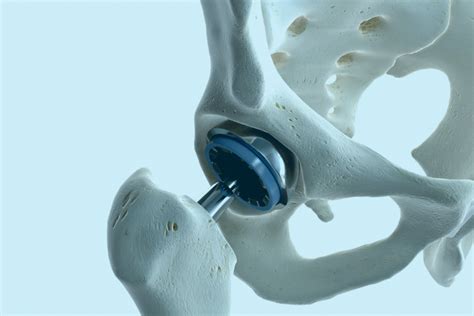 Are Cobalt Chrome Hip Implants An Increased Health Risk Prof J Queally
