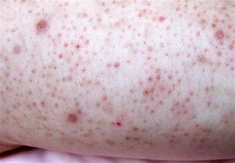 Red Bumps On Upper Arms