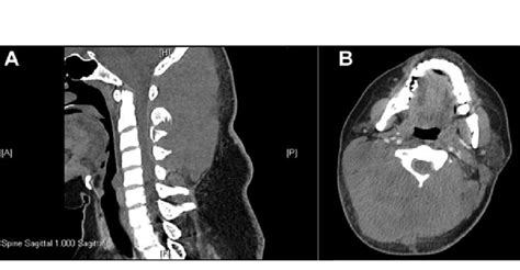 Computed Tomography Scan Of The Neck Showing A Soft Tissue Mass At The