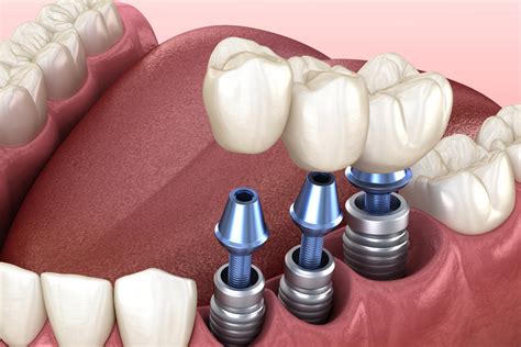 Fully Restore Your Missing Teeth With Dental Implants Phoenix Az