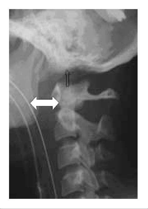 Lateral Cervical Spine Radiograph There Is Prevertebral Soft Tissue