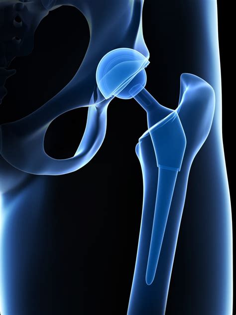 What Is An Anterior Approach Total Hip Replacement Surgery Orlando