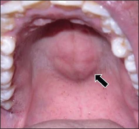 Swellings In The Angle Of Mandible Floor Of Mouth And Palate Dentowesome