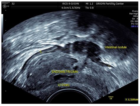Diagnostics Free Full Text Transvaginal Ultrasound As A First Line
