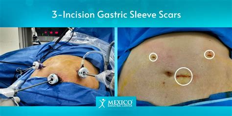 Gastric Sleeve Scars Guide To Reduce Scarring Quickly