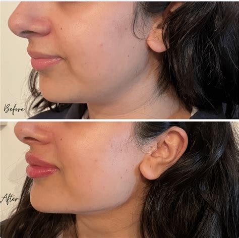 Before And After Of Jawline Filler — Persona Medical Aesthetics Skin