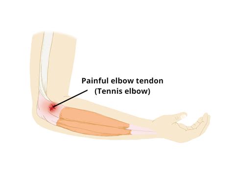 Tennis Elbow Circle Integrated Care