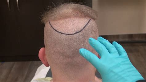 Fue Donor Scars Follicular Unit Extraction Hair Transplant Scars 1 Year