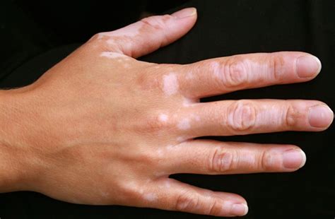 Vitiligo Pictures Symptoms Causes Treatment 2018 Updated