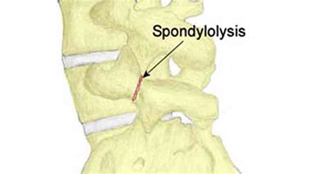 Spondylolysis Symptoms Causes And Treatment
