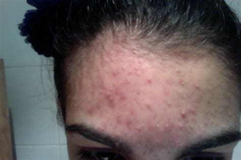 Small Clear Bumps On Forehead General Acne Discussion By Limepencil