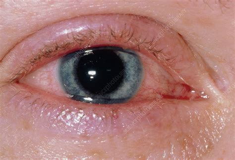 Corneal Ulcers Due To Contact Lens Wearing Stock Image M1550149
