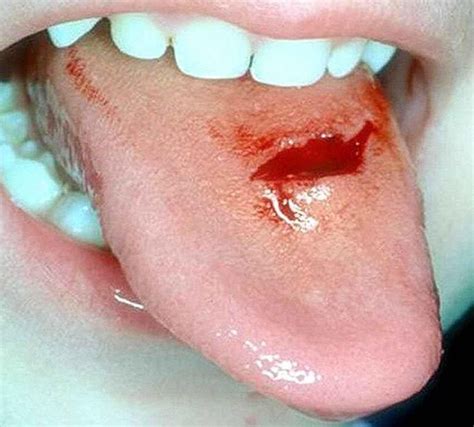 Black Spots On Tongue Causes Small Under Tongue On Tip