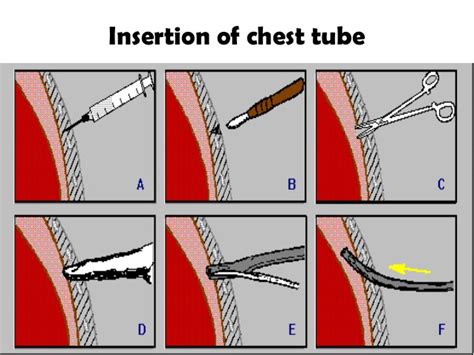 Chest Tube Insertion Or Tube Thoracostomy Epomedicine