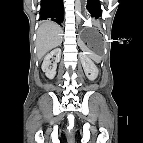 Ct Scan Of The Abdomen Showing Splenic Abscess Which Has