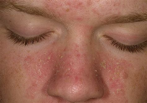 Seborrheic Dermatitis Pictures On Face Scalp Hair Loss Causes