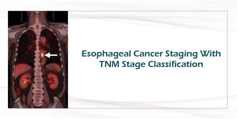 Esophageal Cancer Staging With Tnm Stage Classification