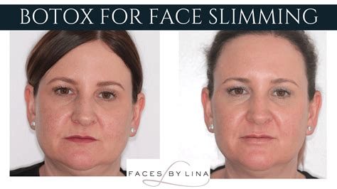 Botox Lower Face Before And After