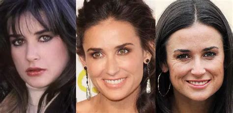 Julia Roberts Plastic Surgery Before And After