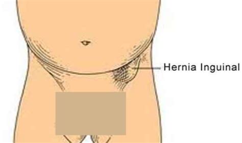 Setiap saluran inguinal berada di dasar perut. Hernia Inguinalis : Gejala, Penyebab, Pengobatan - Mediskus