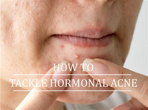 What Is Hormonal Acne Wikiplacenta
