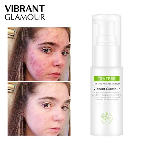 Vibrant Glamour Tea Tree Oil Acne Treatment Face Serum Anti Acne Scar