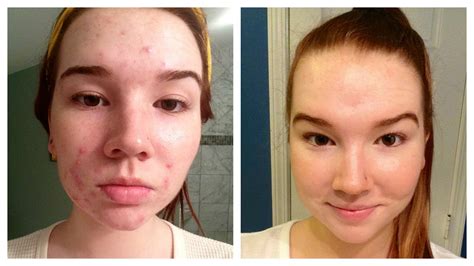 How I Cleared My Acne Before And After Pictures Youtube