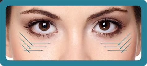 Have you heard of the cat eye thread lift? pdo lift eye | Thread lift, Thread lift face, Facial ...
