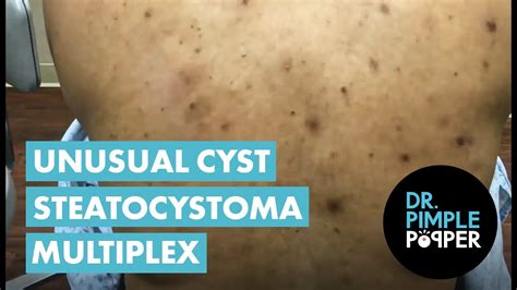 An Unusual Cyst Steatocystoma Multiplex Youtube
