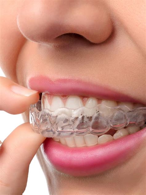 It provides a quick and. Retainers | Orthodontist Ottawa ON | Centrepointe Orthodontics