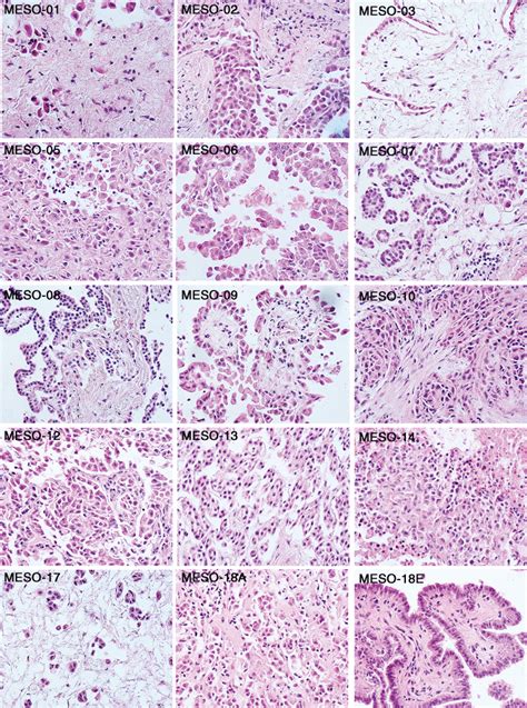 Fig S2 Pathology Of Peritoneal Mesothelioma Microphotographs Of
