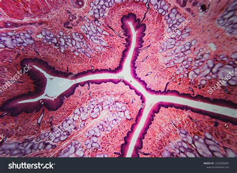 Esophageal Webs And Rings Background Pathophysiology