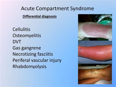Ppt Acute Compartment Syndrome Powerpoint Presentation Free Download