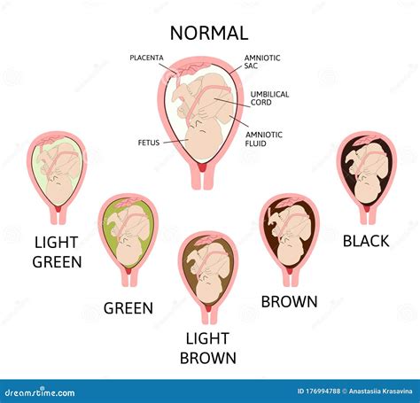 Color Of Amniotic Fluid In The Amniotic Sac Normal And Danger Variants Stock Vector
