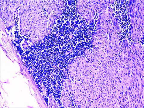 Lymphnode Biopsy Showing Metastatic Spindle Cell Melanoma H And E X40