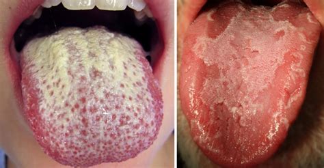 Here Are Some Causes Of White Tongue And How To Fix It Health Nigeria