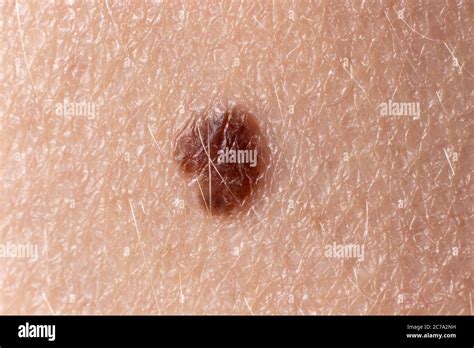 Mole Birthmark Nevus Macro Photo On Human Skin Close Up Stock Photo