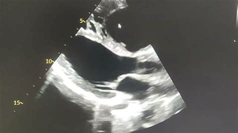 Ostium Secundum Atrial Septal Defect Echocardiography Youtube