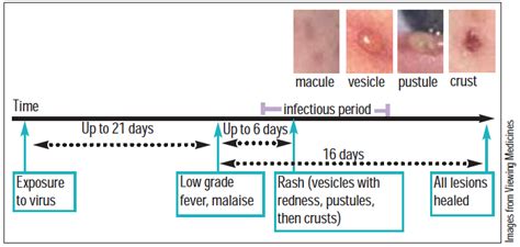 Chickenpox And Shingles Infection The Pharmaceutical Journal