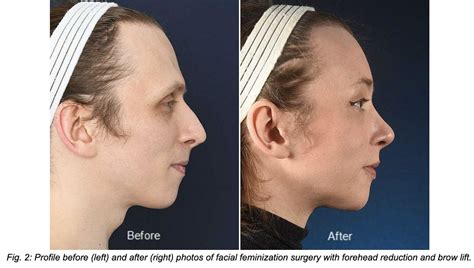 Forehead Contouring Tran Plastic Surgery
