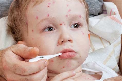 Chicken pox is a form of viral infection caused by the varicella zoster virus. Mengapa Kita Panggil Penyakit Cacar Air 'Chickenpox ...