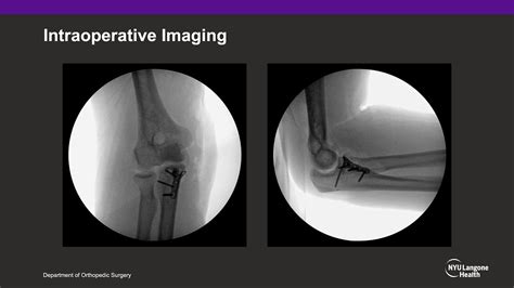 Operative Fixation Of The Anteromedial Facet Of The Coronoid Process