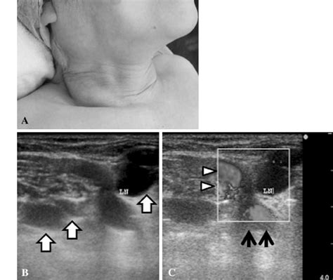 Abnormally Enlarged Lymph Nodes Around The Internal Jugular Vein A