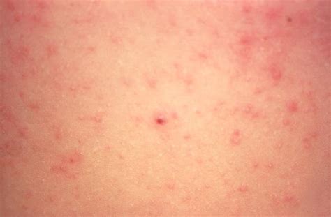 Rash Under Breast Causes Treatments And More